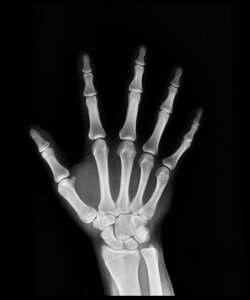 Australian Federal Police (AFP) used controversial wrist x-rays to determine age